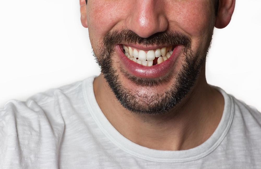 Why it’s Essential to Replace Missing Teeth