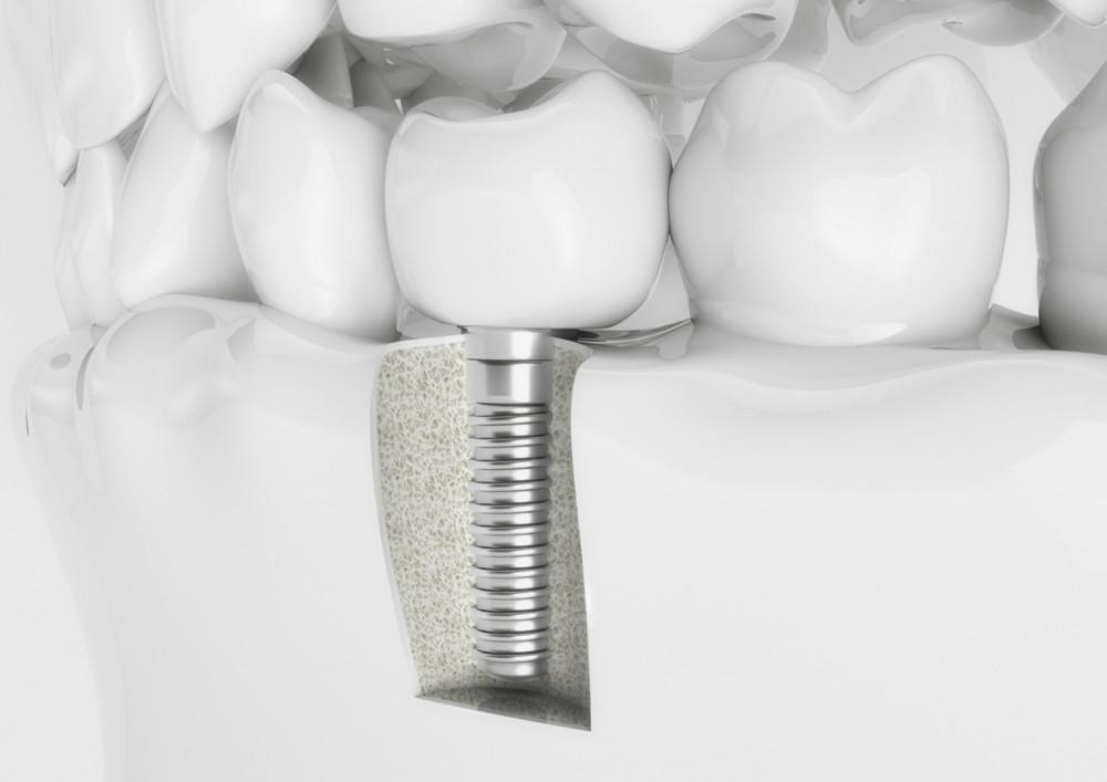 Is Getting a Dental Implant Painful?