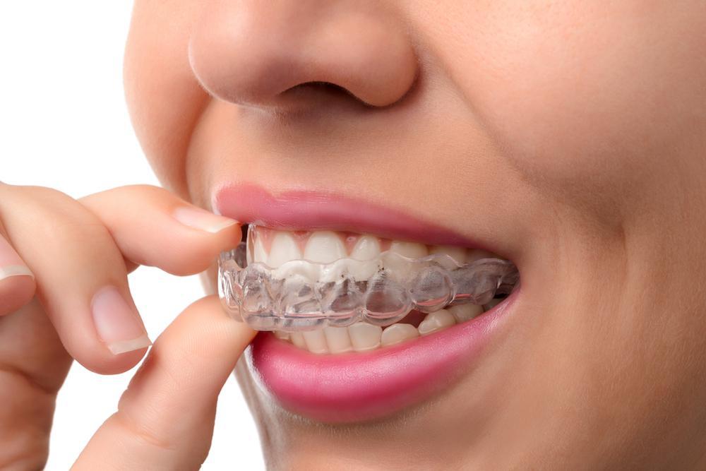 Get Straight Teeth at Any Age With Invisalign Clear Aligners
